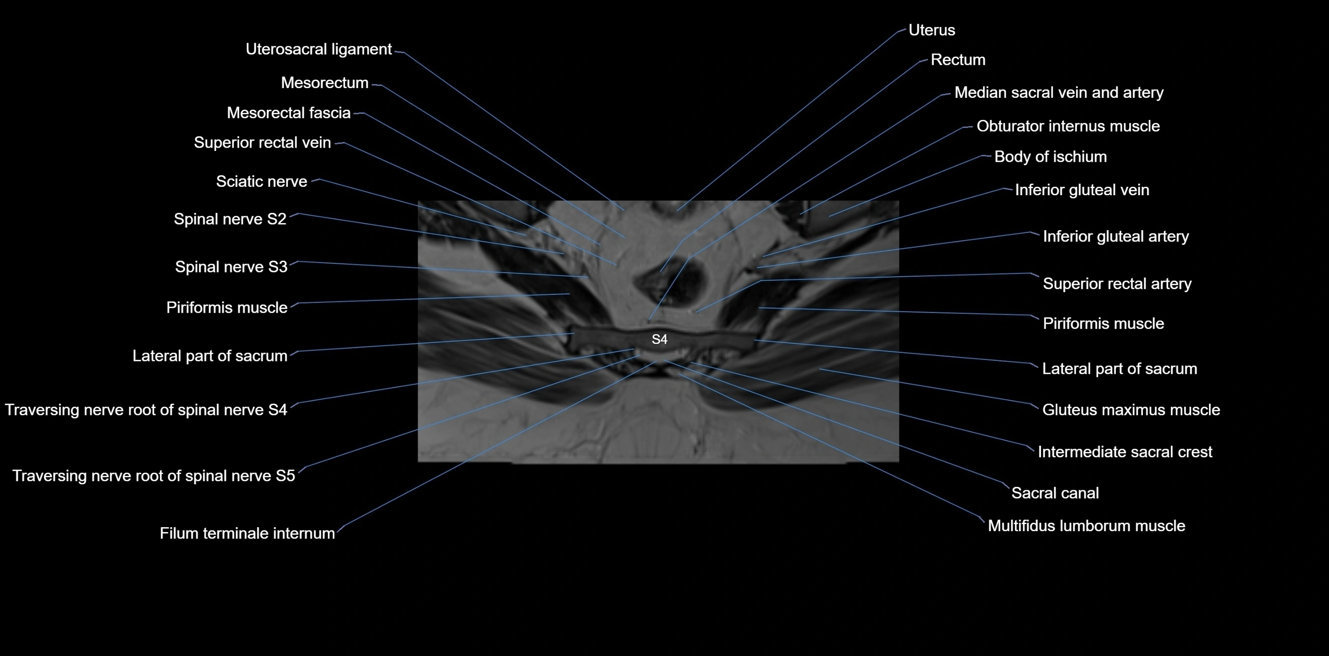 MRI sacrum, coccyx and sacroiliac joint axial cross sectional anatomy 3T  radiology  image-img-00001-00049.webp